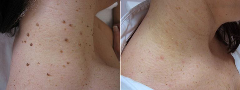 Electrolysis, Red veins & Skin tags removal - Health and Beauty | An